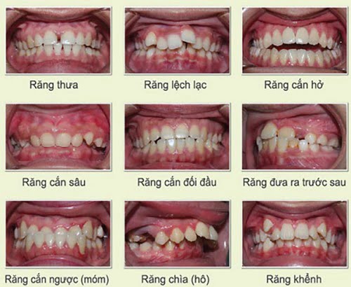 Niềng răng có ảnh hưởng đến thần kinh và sức khỏe không? 2