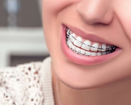 Niềng răng có ảnh hưởng đến thần kinh và sức khỏe không? 3