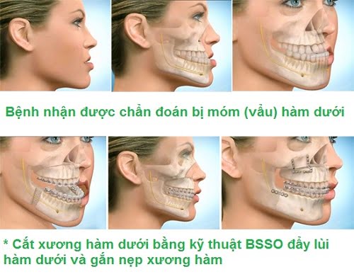 Niềng răng có hết móm không? Móm hàm phải làm sao? 3 Niềng răng có hết móm không? Móm hàm phải làm sao? 3