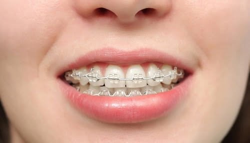 Niềng răng có nguy hiểm không? Giải đáp khách hàng 1