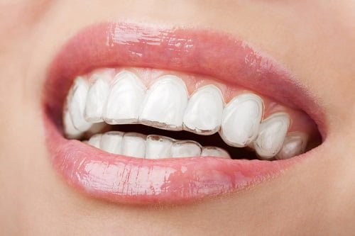 Niềng răng có nguy hiểm không? Giải đáp khách hàng 2