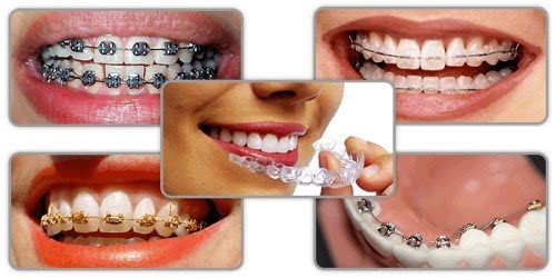 Niềng răng giai đoạn nào đau nhất? Cần lưu ý gì? 1
