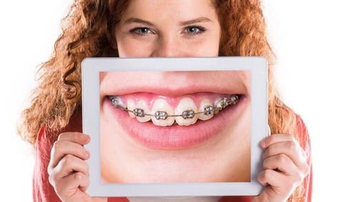 Niềng răng giai đoạn nào đau nhất? Cần lưu ý gì? 2
