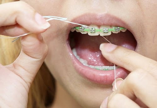Niềng răng giai đoạn nào đau nhất? Cần lưu ý gì? 4
