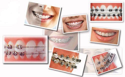 Niềng răng khi mang thai - Những điều cần ghi nhớ 1 Niềng răng khi mang thai - Những điều cần ghi nhớ 1