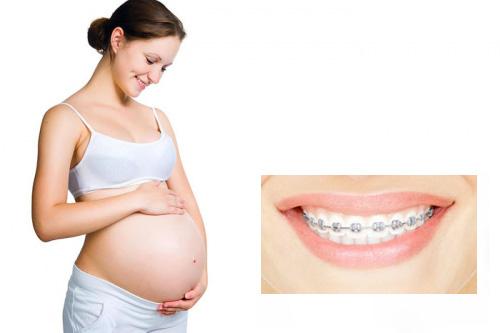Niềng răng khi mang thai - Những điều cần ghi nhớ 2