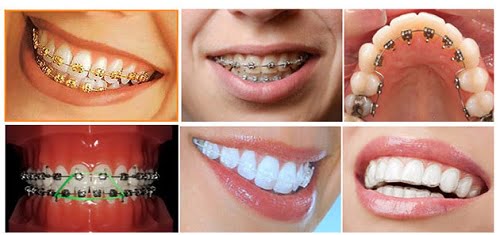 Niềng răng lệch nhân trung bằng khí cụ mắc cài 4 Niềng răng lệch nhân trung bằng khí cụ mắc cài 4