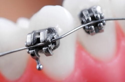 Niềng răng mắc cài kim loại tự buộc có thực sự tốt? 1