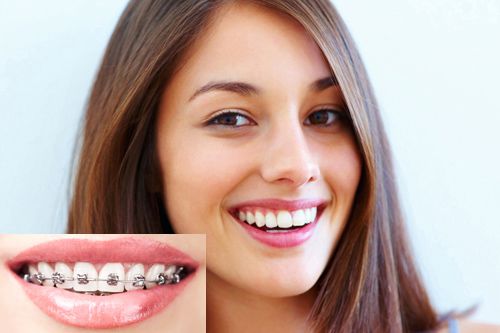 Niềng răng mắc cài kim loại tự buộc có thực sự tốt? 3