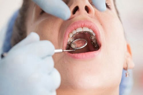 Niềng răng mắc cài mặt lưỡi thực hiện theo quy trình chuẩn 4