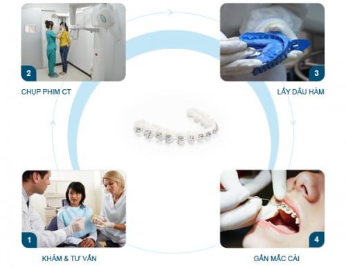 Niềng răng mắc cài sứ có đau không khi gắn mắc cài? 3 Niềng răng mắc cài sứ có đau không khi gắn mắc cài? 3