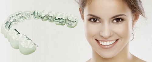 Niềng răng mặt trong là gì? Quy trình tiến hành thế nào? 2 Niềng răng mặt trong là gì? Quy trình tiến hành thế nào? 2