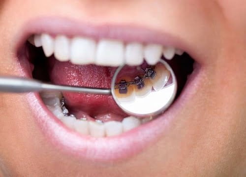 Niềng răng mặt trong mất bao lâu là răng đẹp hoàn thiện? 1 Niềng răng mặt trong mất bao lâu là răng đẹp hoàn thiện? 1