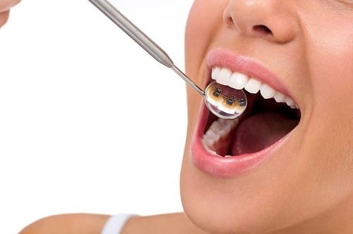 Niềng răng mặt trong mất bao lâu là răng đẹp hoàn thiện? 3