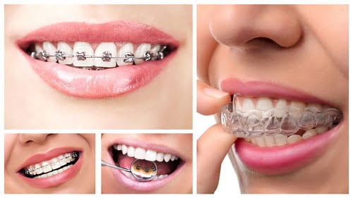 Niềng răng móm mất bao lâu nếu bị móm do răng? 3