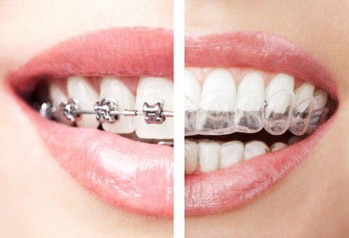 Niềng răng phải đeo hàm duy trì bao lâu? Vì sao phải đeo? 1