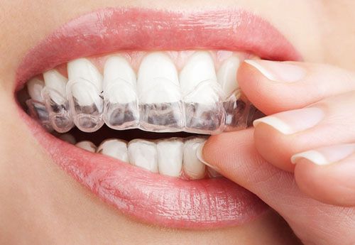 Niềng răng trong suốt có hiệu quả không với răng lệch lạc? 2