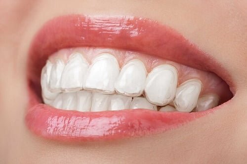 Niềng răng trong suốt mất bao lâu là hoàn thành ca chỉnh nha? 1