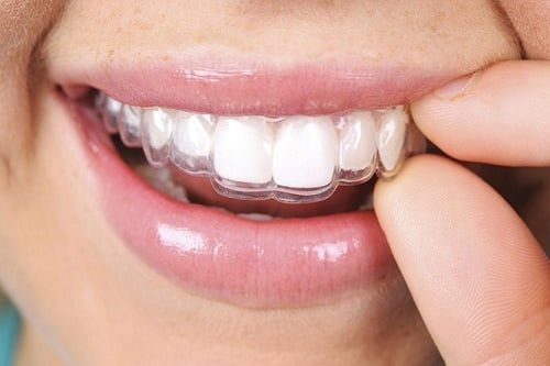 Niềng răng trong suốt mất bao lâu là hoàn thành ca chỉnh nha? 2