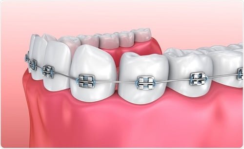 Răng bọc sứ có niềng được không? Cần chú ý những gì? 1 Răng bọc sứ có niềng được không? Cần chú ý những gì? 1