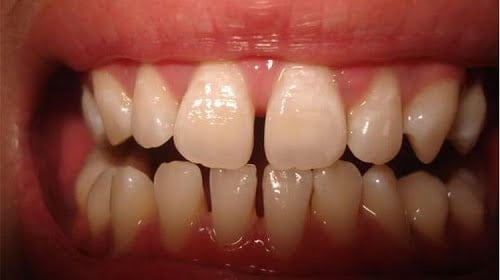 Răng cửa thưa có niềng được không để có hàm răng đẹp? 1