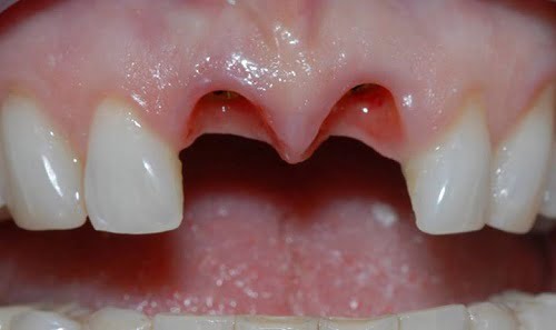 Trồng răng cửa có đau không? Tìm hiểu cách trồng răng cửa 1