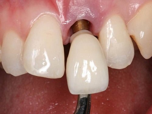Trồng răng cửa có đau không? Tìm hiểu cách trồng răng cửa 2