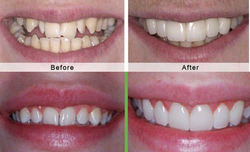 Bọc răng sứ có bền không? Cách chăm sóc hợp lý 1
