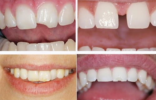Bọc răng sứ có đắt không? Khi nào nên thực hiện? 2 Bọc răng sứ có đắt không? Khi nào nên thực hiện? 2