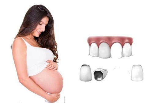 Bọc răng sứ khi mang thai - Điều bạn nên biết 2