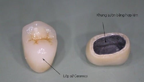 Bọc răng sứ kim loại có bền không? Cách chăm sóc 1