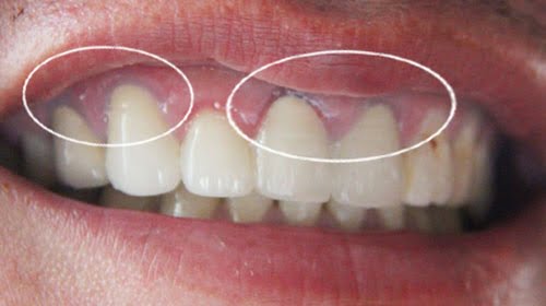 Bọc răng sứ titan có tốt không? Loại nào tốt nhất? 2