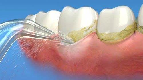 Cạo vôi răng siêu âm có an toàn không? 2