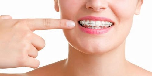 Ê buốt khi niềng răng - Nguyên nhân và cách xử lý 1