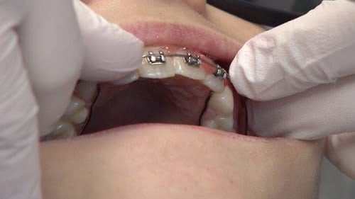 Ê buốt khi niềng răng - Nguyên nhân và cách xử lý 3