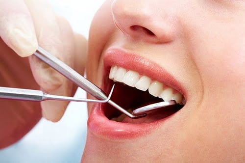 Lấy cao răng có ảnh hưởng không? Tìm hiểu ngay 