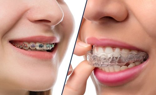 Niềng răng bị hỏng bạn cần làm gì để khắc phục? 1 Niềng răng bị hỏng bạn cần làm gì để khắc phục? 1
