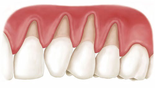 Niềng răng bị lòi chân răng nguyên nhân do đâu? 1