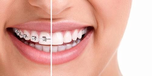 Niềng răng bị lòi chân răng nguyên nhân do đâu? 3 Niềng răng bị lòi chân răng nguyên nhân do đâu? 3