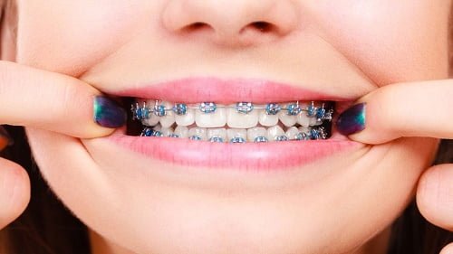 Niềng răng gây hôi miệng thực hư thế nào? Cách khắc phục 2