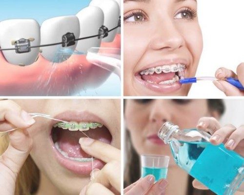 Niềng răng gây hôi miệng thực hư thế nào? Cách khắc phục 3