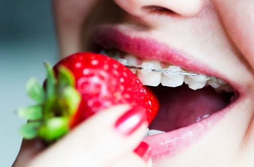 Niềng răng gây hôi miệng thực hư thế nào? Cách khắc phục 4
