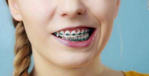 Niềng răng lệch hàm - Các yếu tố chi phối thời gian điều trị 1