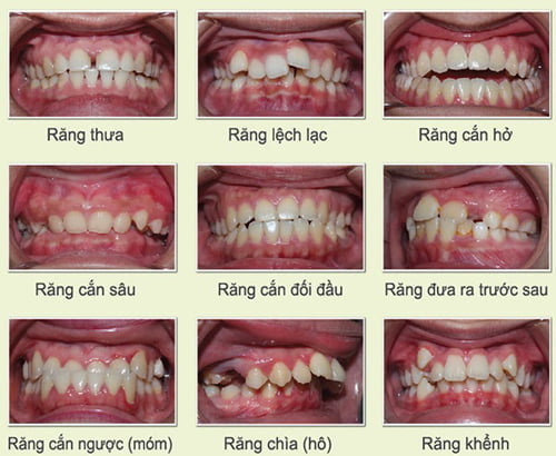 Niềng răng lệch hàm - Các yếu tố chi phối thời gian điều trị 2