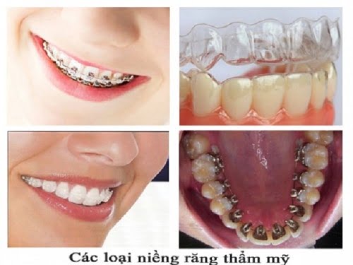 Niềng răng uy tín tại tphcm - Tiêu chí đánh giá địa chỉ nha khoa 4 Niềng răng uy tín tại tphcm - Tiêu chí đánh giá địa chỉ nha khoa 4