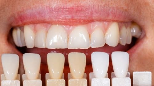 Bọc răng sứ có hại không? Địa chỉ nha khoa uy tín 1