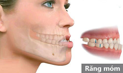 Bọc răng sứ có hết móm không? Cách nào chữa móm tốt? 2 Bọc răng sứ có hết móm không? Cách nào chữa móm tốt? 2