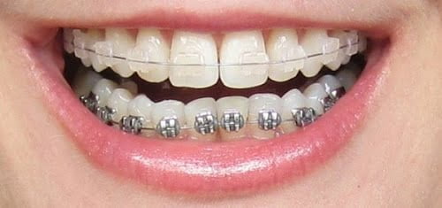 Bọc răng sứ có hết móm không? Cách nào chữa móm tốt? 3 Bọc răng sứ có hết móm không? Cách nào chữa móm tốt? 3