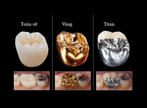 Bọc răng sứ kim loại có tốt không? Loại nào tốt nhất? 3 Bọc răng sứ kim loại có tốt không? Loại nào tốt nhất? 3