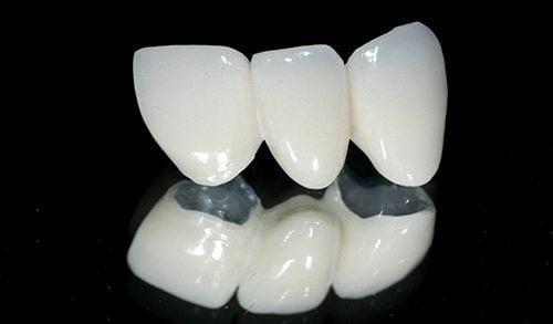 Bọc răng sứ kim loại thường - Các thông tin cơ bản 1 Bọc răng sứ kim loại thường - Các thông tin cơ bản 1